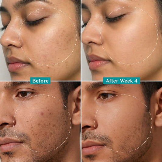 Pilgrim 10% Niacinamide Face Serum | With Kojic Acid & Korean Rice Water | Reduces Acne Marks & Minimizes Pores | Glass Skin Serum | 30ml